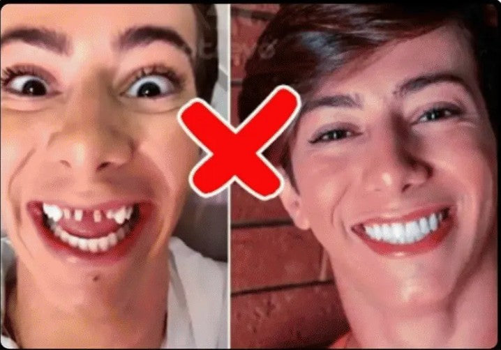 CARILLAS DENTALES
