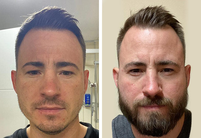 Serum Premium Para crecimiento de Barba