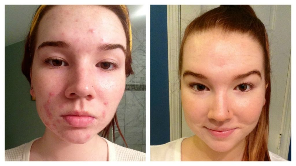 ANTI-ACNE BIOAQUA