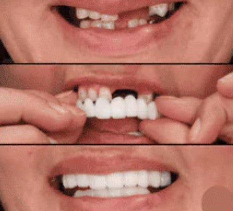 CARILLAS DENTALES