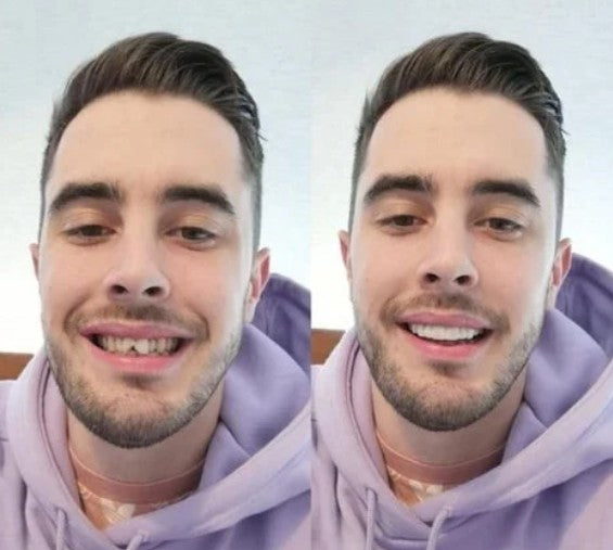 CARILLAS DENTALES