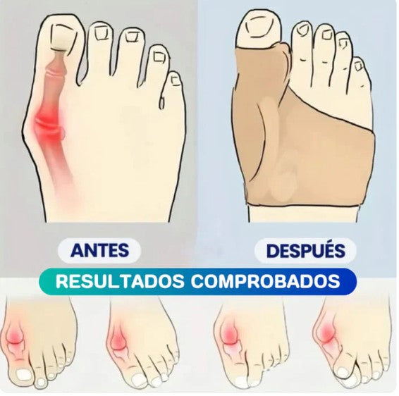 CORRECTOR DE JUANETE CON GOMA POR PAR